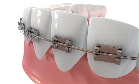 thin braces wire